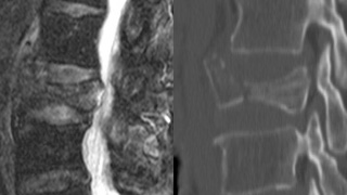 irvertaugmentation5