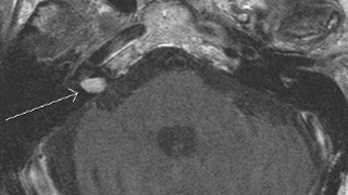 mriauditoarycanals3