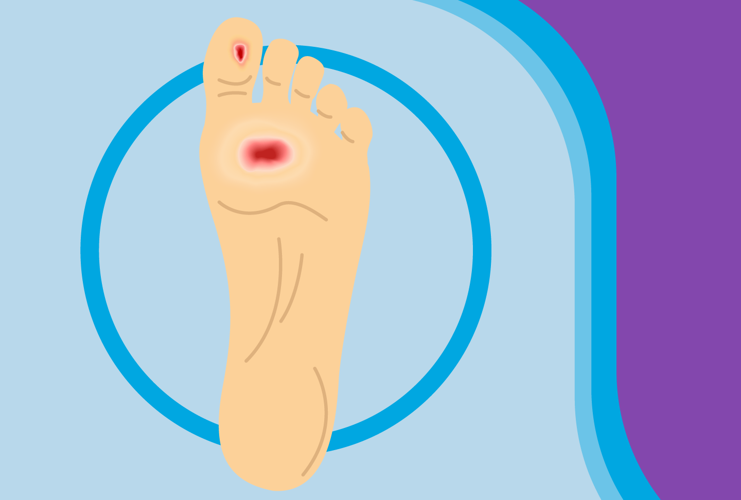 Illustration of diabetic foot ulcer.