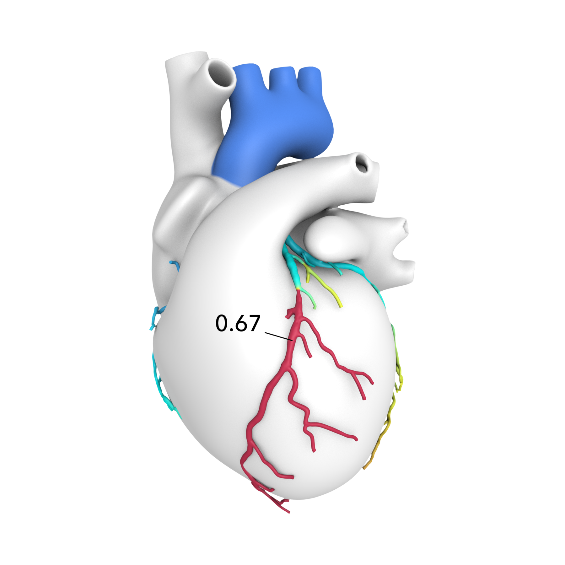 A leading edge technology called HeartFlow Analysis combines CT imaging with powerful computer algorithms to create a personalized, color coded 3D model of coronary arteries. 